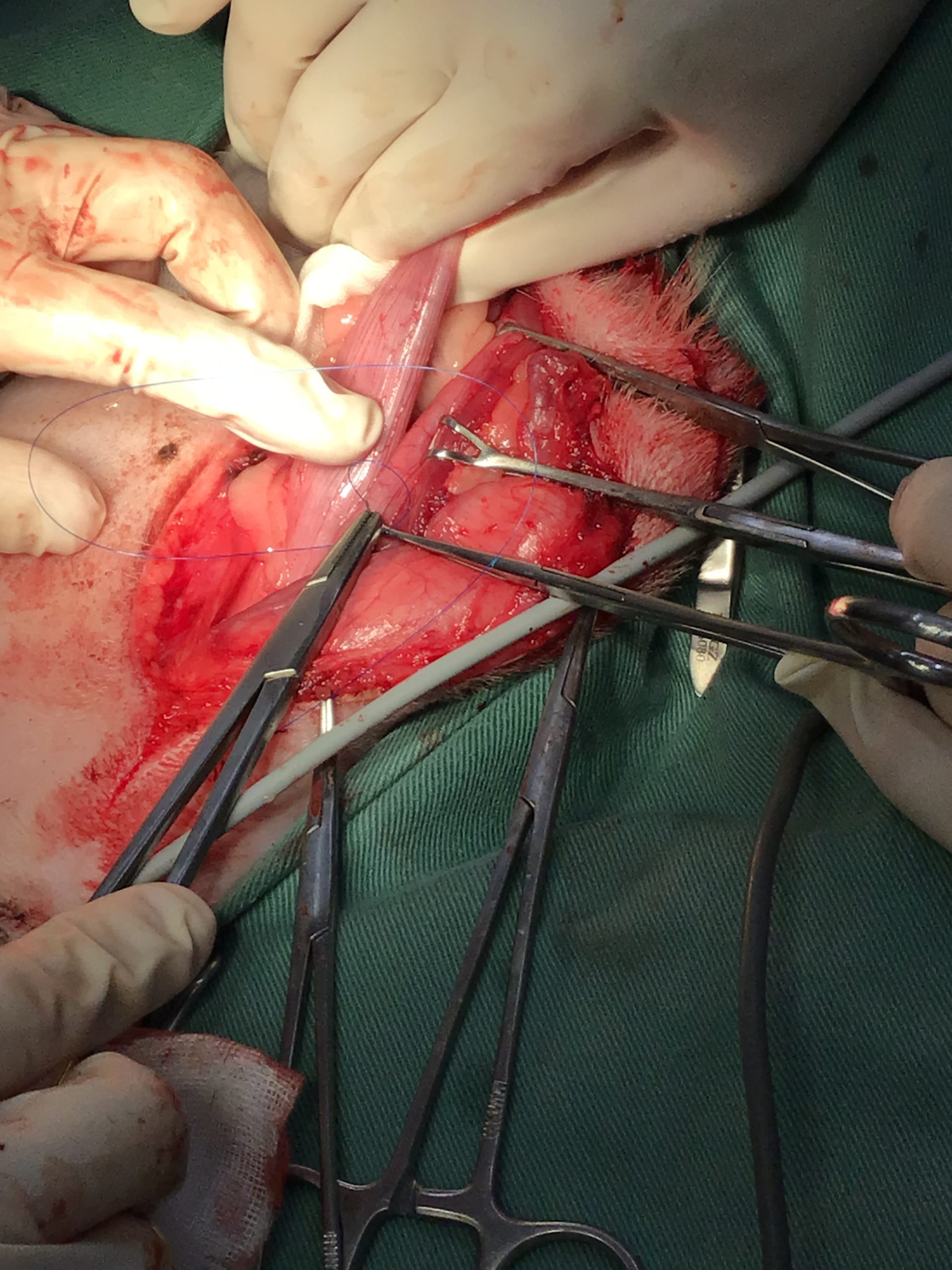 結腸固定手術の画像